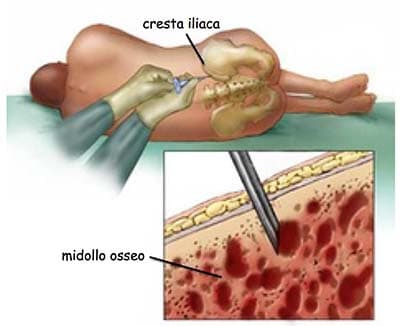 C'è qualcuno che dona il midollo osseo? Oppure conoscete qualcuno su insegreto che lo fa?