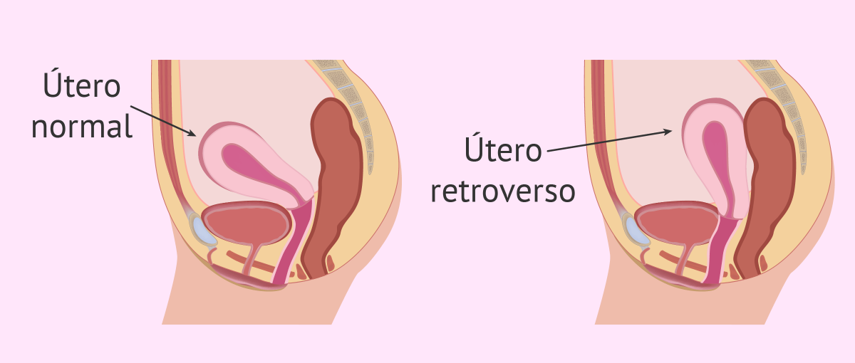 L'utero retroverso è quando i lbambino esce dal culo